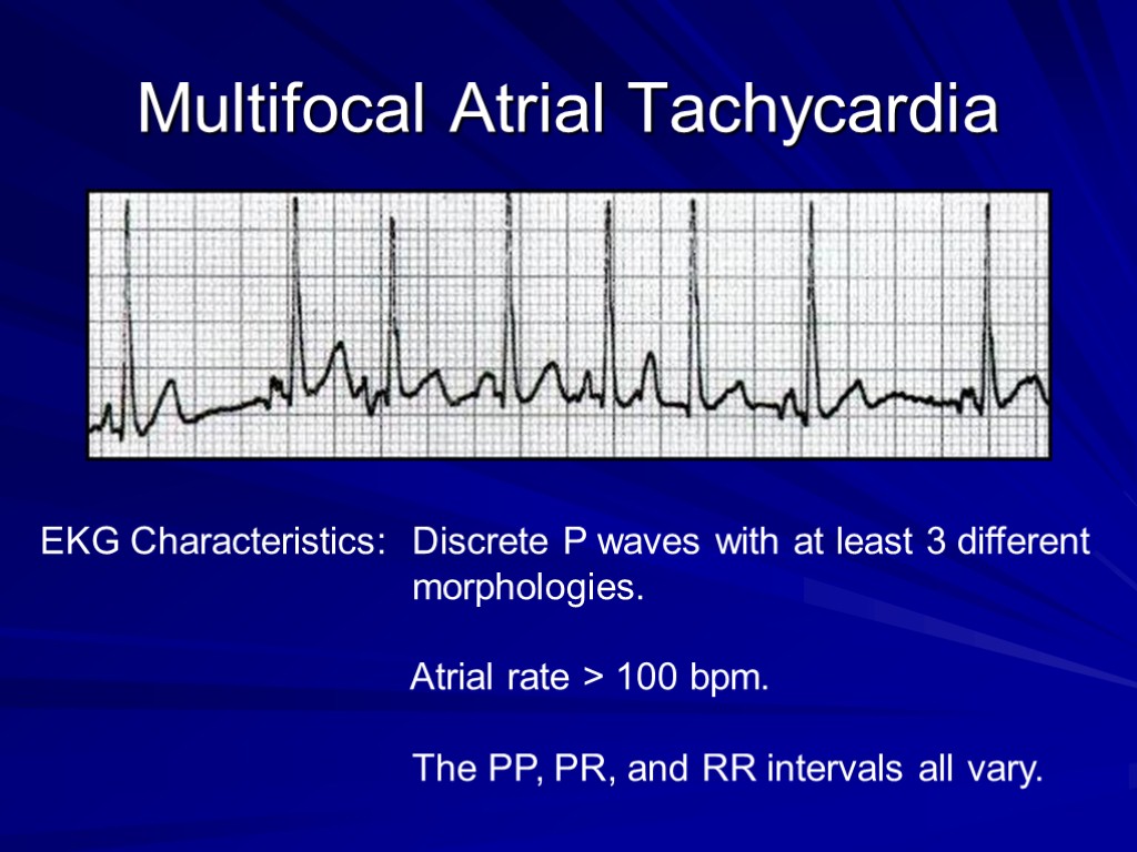 Multifocal Atrial Tachycardia EKG Characteristics: Discrete P waves with at least 3 different morphologies.